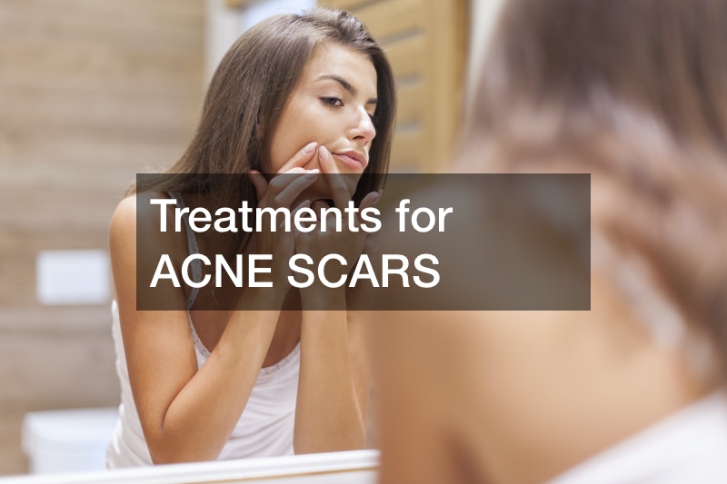 Treatments for ACNE SCARS